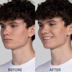 FOREO ESPADA Blue Light Acne Treatment Device -FOREO || Braun || Therabody Shop 7350092130011 07 1 1