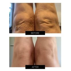 LYMA Laser (Red) System Starter Kit & Free CurrentBody Skin Skincare -FOREO || Braun || Therabody Shop B A 3 1 cff1f263 76f7 4a6a 8652 710c3da3b9ee