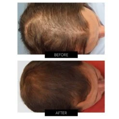 CapillusPlus Hair Regrowth Laser Cap -FOREO || Braun || Therabody Shop B A CAPILLUS 1 COM 1 ee0a036b 720e 4dc3 9d94 1f3ece4f13ac