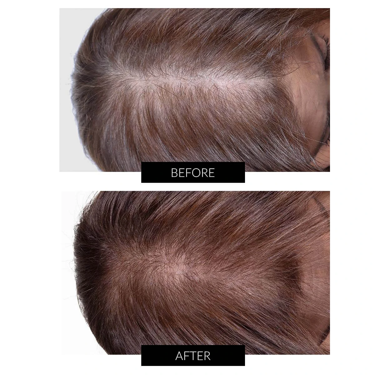 CapillusUltra Laser Cap For Hair Regrowth 8 CapillusUltra Laser Cap For Hair Regrowth - Image 6