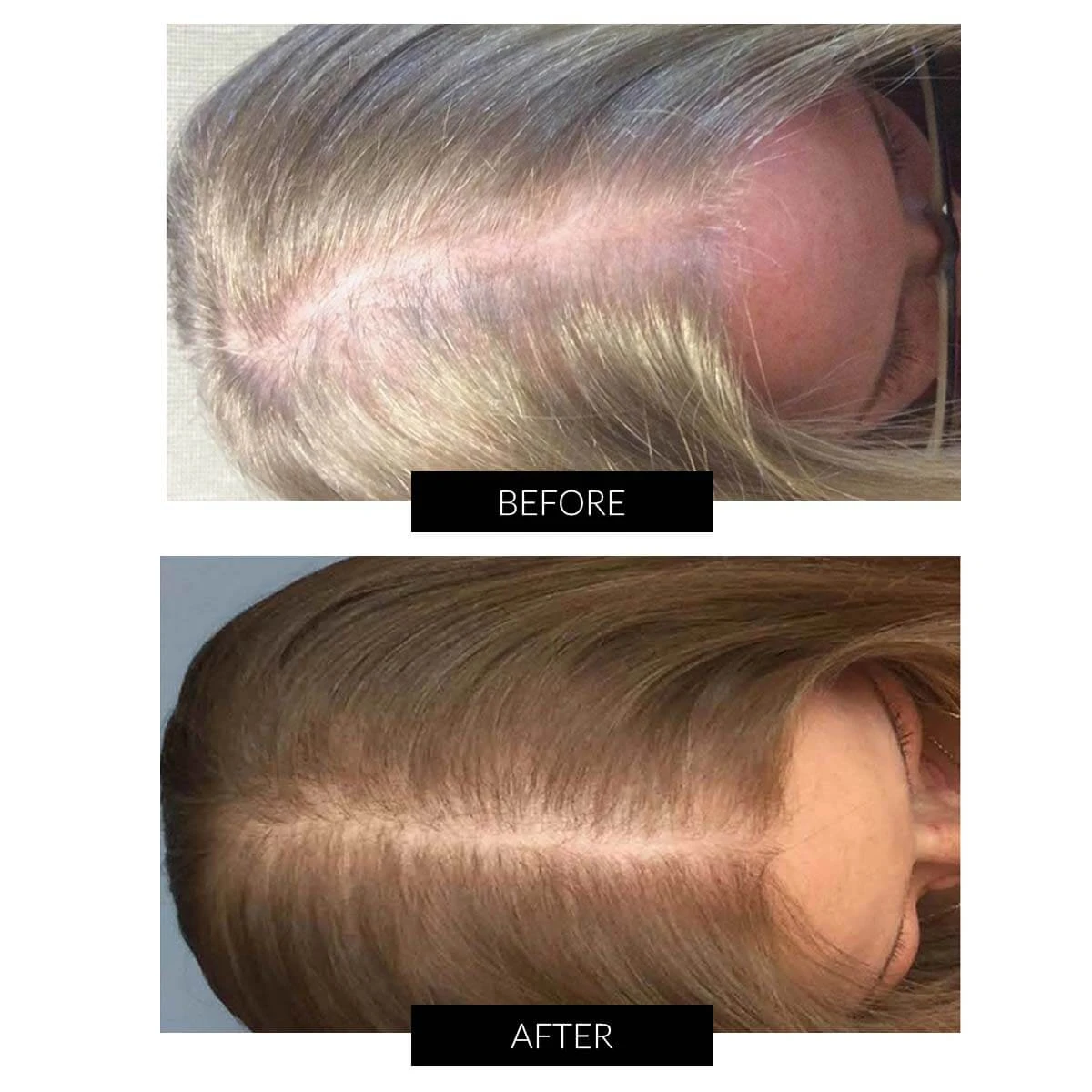 CapillusUltra Laser Cap For Hair Regrowth 7 CapillusUltra Laser Cap For Hair Regrowth - Image 5