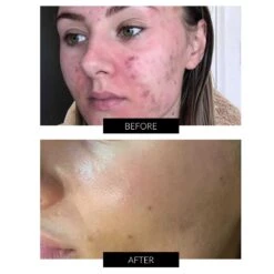 Dermalux Flex MD LED Light Therapy Device -FOREO || Braun || Therabody Shop B A DERMALUX 1 COM 2