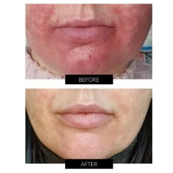 Dermalux Flex MD LED Light Therapy Device -FOREO || Braun || Therabody Shop B A DERMALUX 3 COM 2