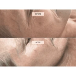 Dermalux Flex MD LED Light Therapy Device -FOREO || Braun || Therabody Shop Customer2 DermaluxFlex1200x1200px