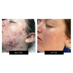 Dermalux Flex MD LED Light Therapy Device -FOREO || Braun || Therabody Shop FLUX 1