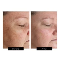 Dermalux Flex MD LED Light Therapy Device -FOREO || Braun || Therabody Shop FLUX 1 1