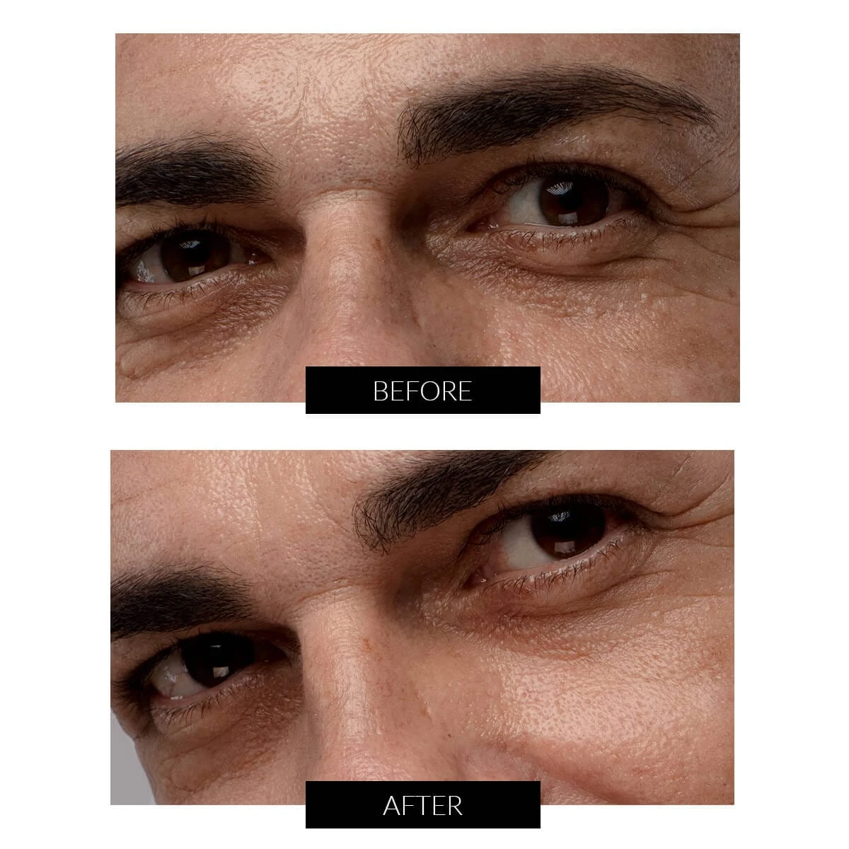 FOREO IRIS 2 Rejuvenating Eye Massager 5 FOREO IRIS 2 Rejuvenating Eye Massager - Image 3