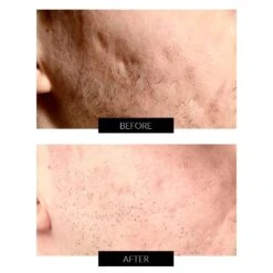 LYMA Laser (Red) System Starter Kit & Free CurrentBody Skin Skincare -FOREO || Braun || Therabody Shop LYMA ScarringB A 1 COM copy 2 1 3964485a 69bd 4c42 9d0f 3ae8606e4ec7